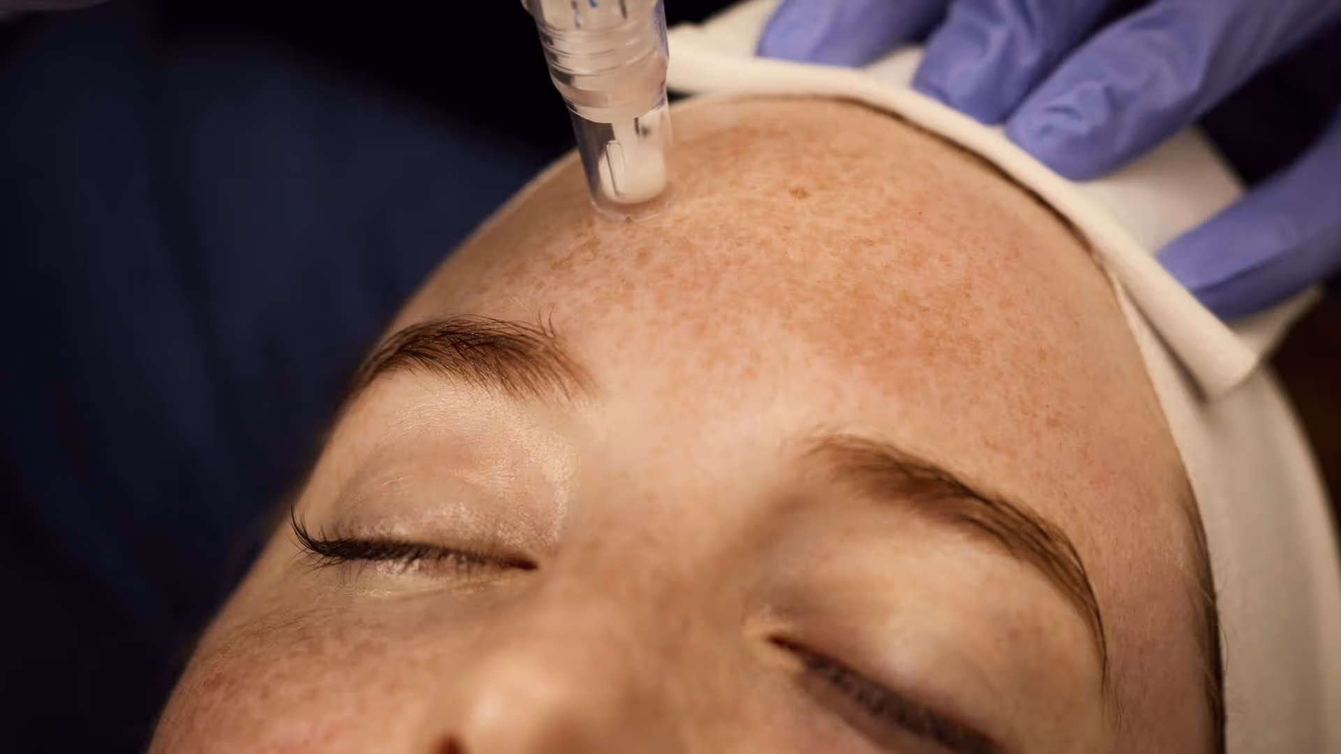 SkinPen® treatment — Proliferation phase