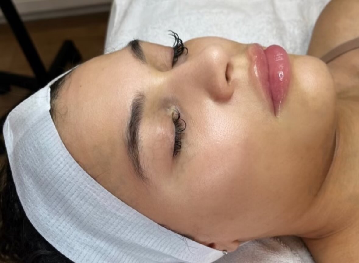After — Acne scars (SkinPen® microneedling)