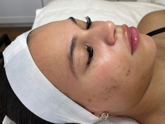 Before — Acne scars (SkinPen® microneedling)